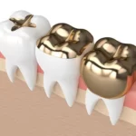 How Much Does Permanent Gold Teeth Cost?
