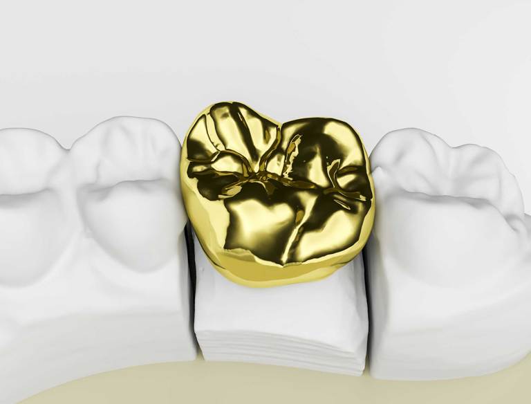 Which Karat is Better for Gold Teeth?